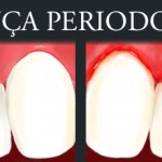 thumb_odo_doenca-periodontal